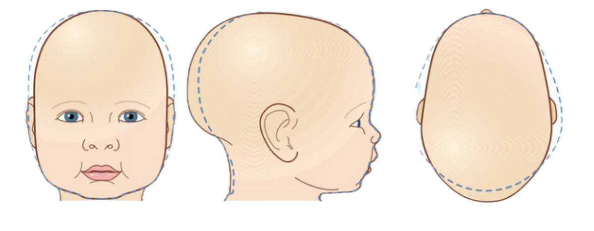 Dolicocefalia